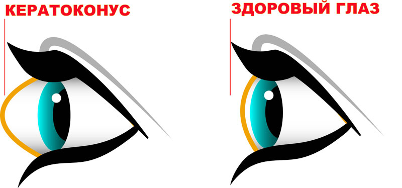 Кератоконус